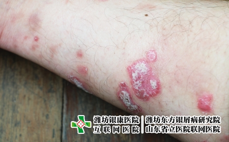 攝圖網(wǎng)_323551459_絲蟲(chóng)病宏觀藥品疾病彎頭發(fā)癢病人醫(yī)療皮膚手臂皮炎（企業(yè)商用）