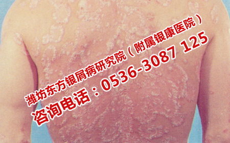 預(yù)防銀屑病的小妙招