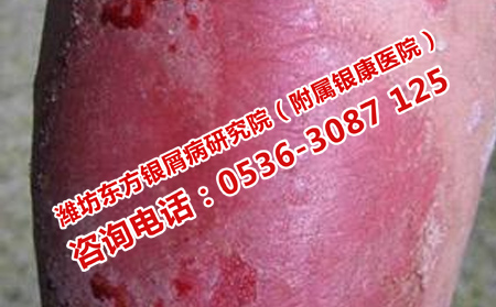 牛皮癬為什么要護理