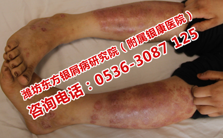 治療牛皮癬理想的醫(yī)院