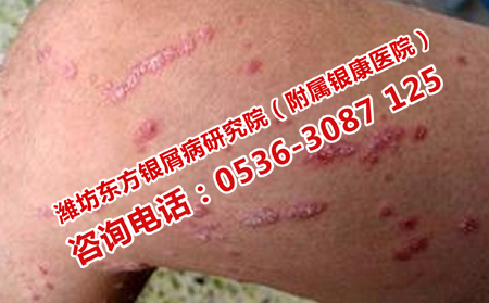 牛皮癬怎么護理理想