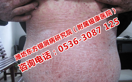 牛皮癬復發的原因是哪些