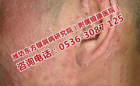 治療牛皮癬醫院理想不理想