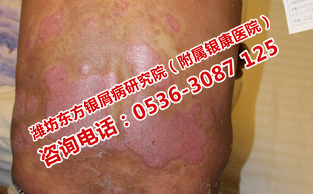 牛皮癬跟什么有關