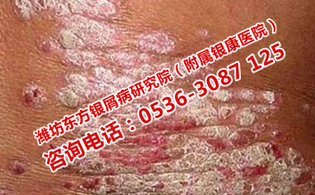 西醫(yī)治療牛皮癬的缺點