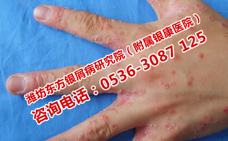在校突發(fā)牛皮癬的原因是什么