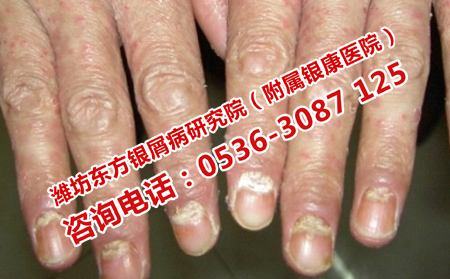 關節(jié)型牛皮癬疼痛怎么辦