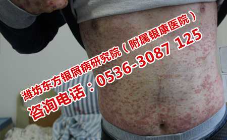 男性牛皮癬患者日常應該注意什么