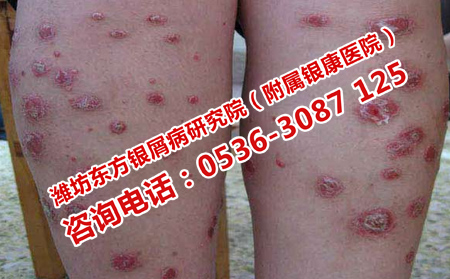 如何正確治療老人銀屑病