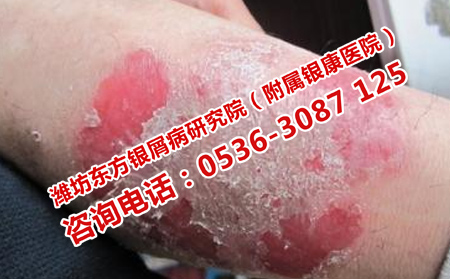 怎樣護理牛皮癬會更理想