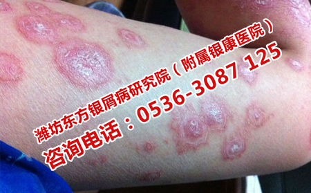如何預(yù)防牛皮癬復(fù)發(fā)