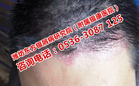 頭部牛皮癬理想轉(zhuǎn)的方法