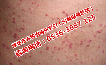 濰坊治療銀屑病的不規范方法有