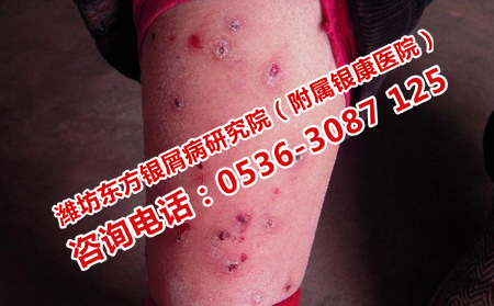 牛皮癬恢復(fù)的治療方法