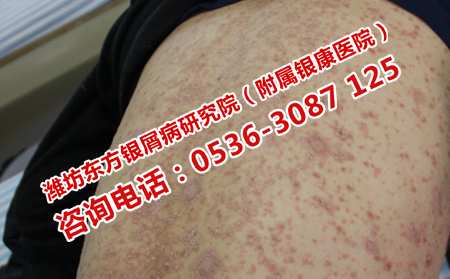 青州理想的牛皮癬醫(yī)生