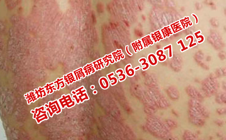 濰坊治療銀屑病的?？漆t院