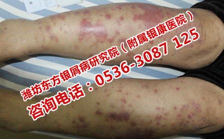 預(yù)防銀屑病丘疹擴(kuò)散