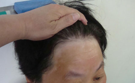 治療白癜風(fēng),早期白斑圖片,早期白癜風(fēng)癥狀,白癜風(fēng)治療方法