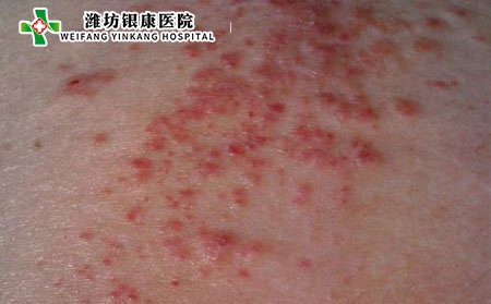 濕疹并發(fā)癥,長(zhǎng)期得濕疹并發(fā)癥