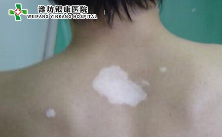 白癜風(fēng)發(fā)病部位,白癜風(fēng)長在哪個(gè)部位