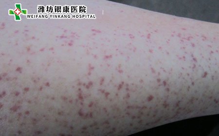 過(guò)敏性紫癜,過(guò)敏性紫癜遺傳嗎