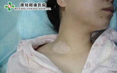 白癜風(fēng)癥狀,白癜風(fēng)癥狀表現(xiàn)