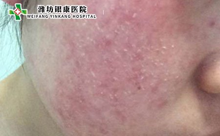 濰坊銀康醫院:中藥防治皮炎