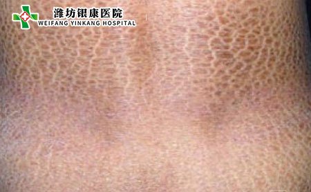 魚(yú)鱗病是什么原因引起的?能治好嗎?