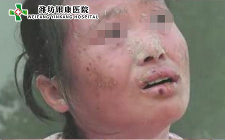 濰坊牛皮癬醫院：中藥治療牛皮癬